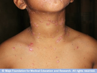 صدفية النقاط