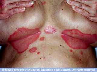 صدفية عكسية