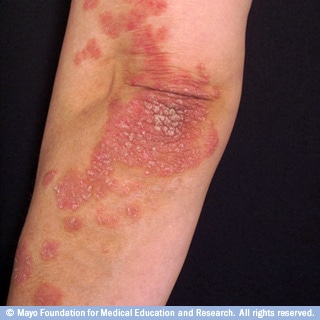 صدفية لويحية