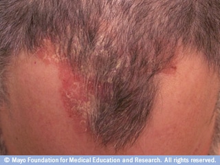 صدفية فروة الرأس