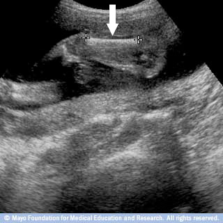 عظم الفخذ لدى الجنين