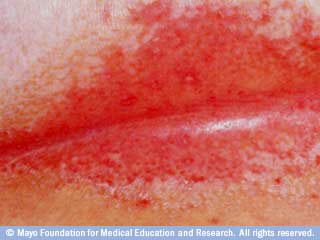 المذح المذح