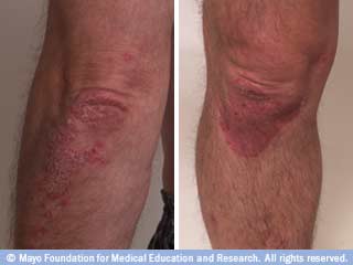 الصدفية الصدفية