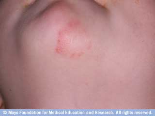 سعفة الجسم سعفة الجسم