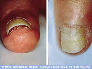 إنفكاك الإظفر