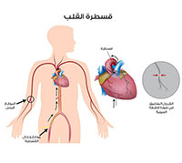 قسطرة القلب عملية قسطرة القلب ويب طب