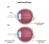 عمليات الليزر للعيون وأبرز المعلومات عنها