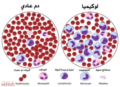 اسباب سرطان الدم