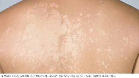 السعفة المبرقشة