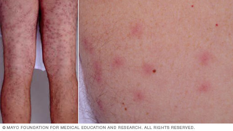 حكة السَّباح