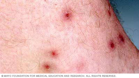 عضات القِذَّان