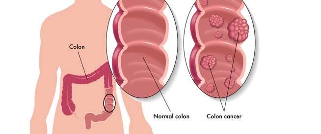 سرطان القولون أعراض وعلاج سرطان القولون ويب طب